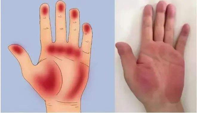 >常笑健康>2024-03-031711>肝掌是指大拇指和小指等手掌根部的大小