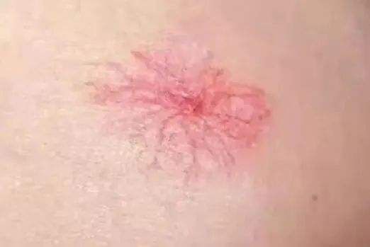 "蜘蛛痣"是一种特发性毛细血管扩张症,好发于面部,颈部,上胸部,肩部及