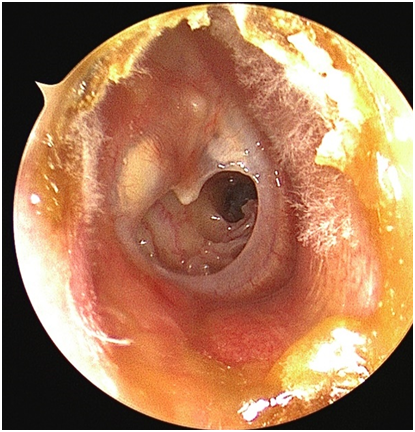 耳鼻喉内镜是什么科援藏专家助力开展耳内镜微创手术_https://www.jmylbn.com_新闻资讯_第2张