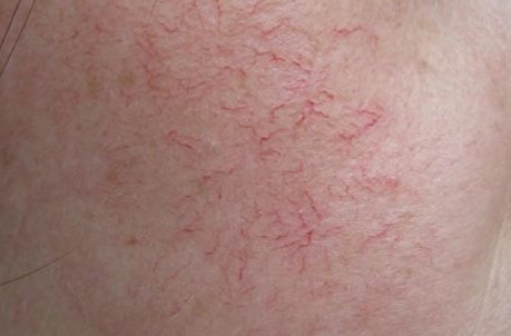 身上有红血丝是皮肤薄?这3个部位千万不能长,赶紧对镜自查